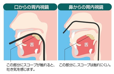 経鼻内視鏡検査について